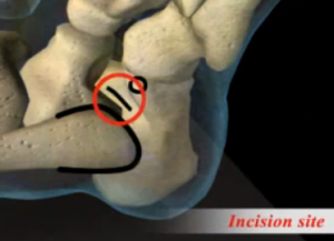 Hyprocure Stent Location