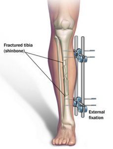 Limb Lengthening Surgery