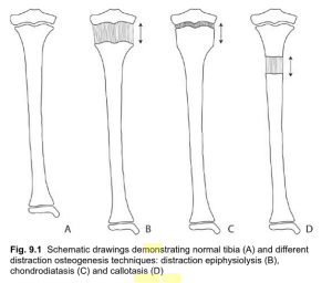 Chondrodiatasis