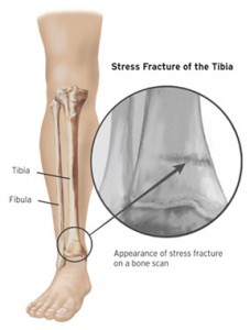 Stress Fracture of the Tibia