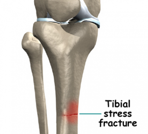 Tibial Stress Fracture