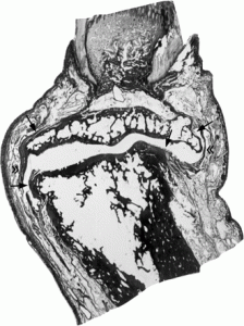 growing osteophyte