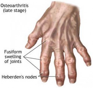 osteoarthritis fingers