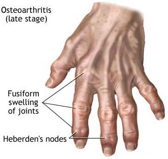 Rheumatoid arthritis steroid injection side effects