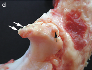 osteophyte on the bone