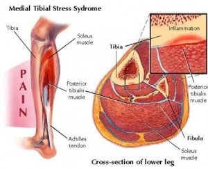 shin_splints