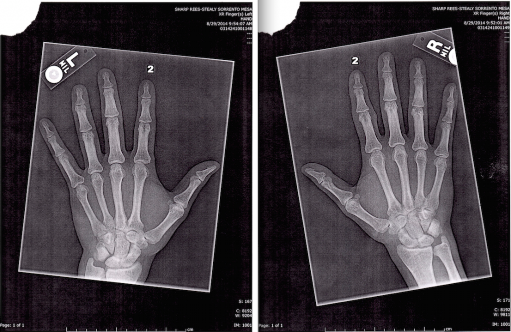 X Rays of Metacarpal