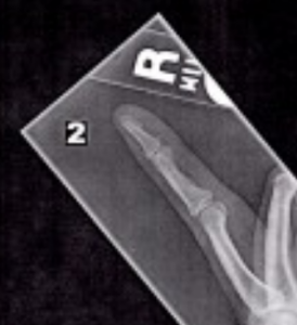 Finger X-Ray