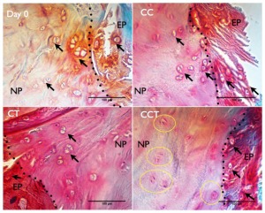 CCT cartilage loss