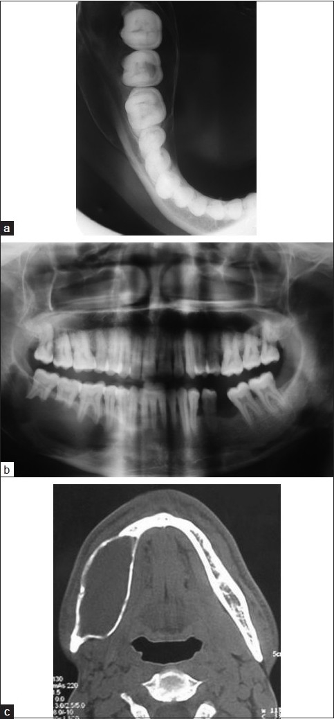 Aneurysmal Bone Cyst To Increase Height Natural Height Growth