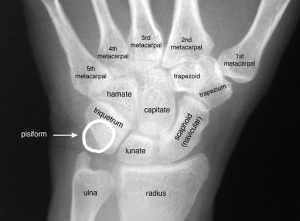 wrist-labeled-xray