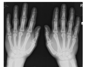 Acromegalic_hand_x-ray 2