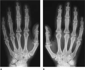 Acromegalic_hand_x-ray 3