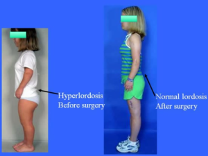 Hyperlordosis