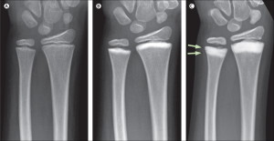 growth plate images