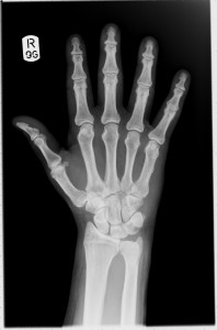 hand xray