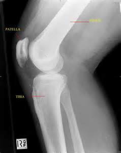 lateral knee xray