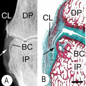 bone cyst enthesis