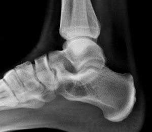 normal calcaneus