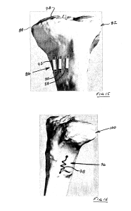 actuators to increase tibia length