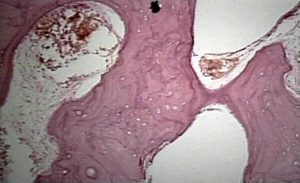 paget's disease bone histology