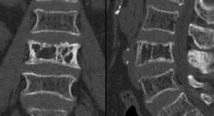 pagets disease spine