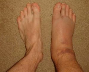 one-swollen-foot