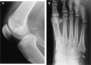 sesamoid-bone